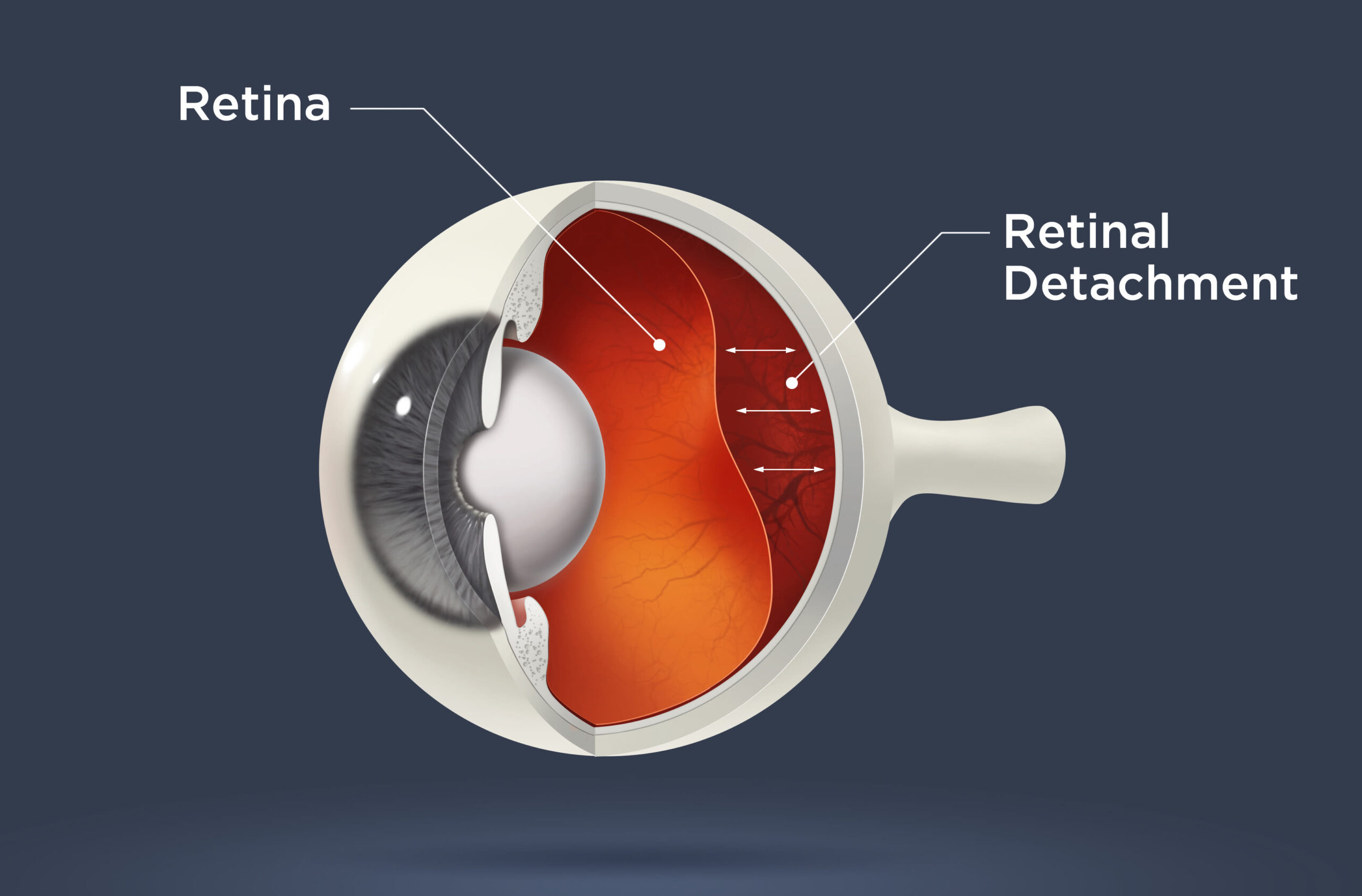 Retina